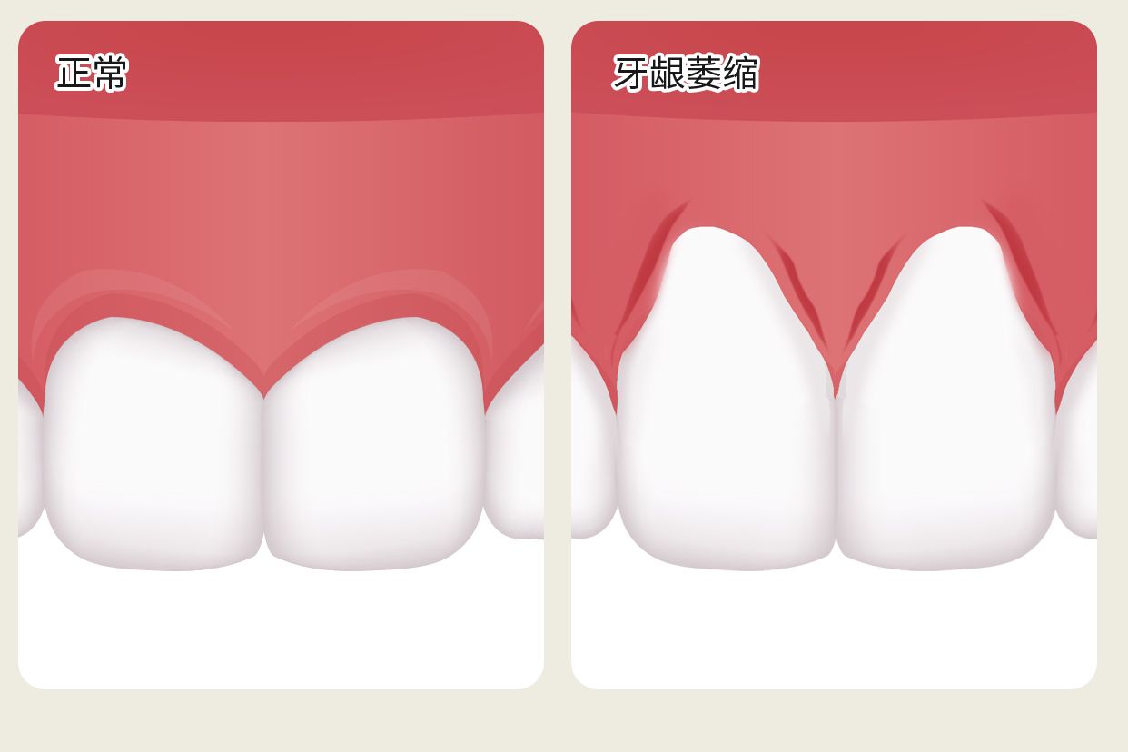 正常没萎缩的牙龈图片（正常牙龈和萎缩牙龈图片）