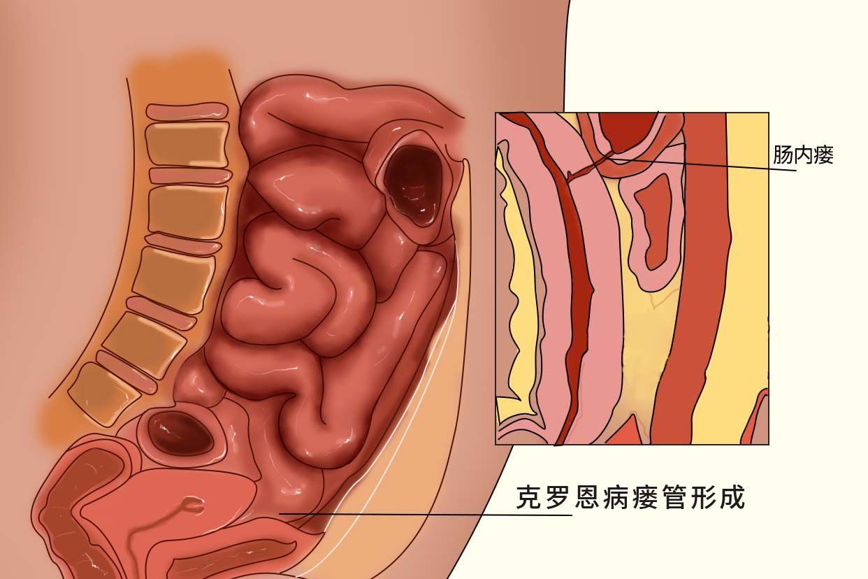 克罗恩病瘘管形成图片（克罗恩造瘘手术是什么）