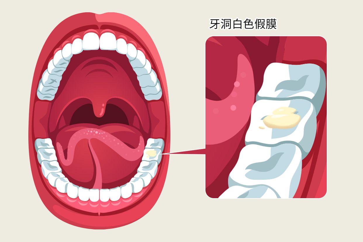 牙洞白色假膜图片 拔智齿后的白色假膜图