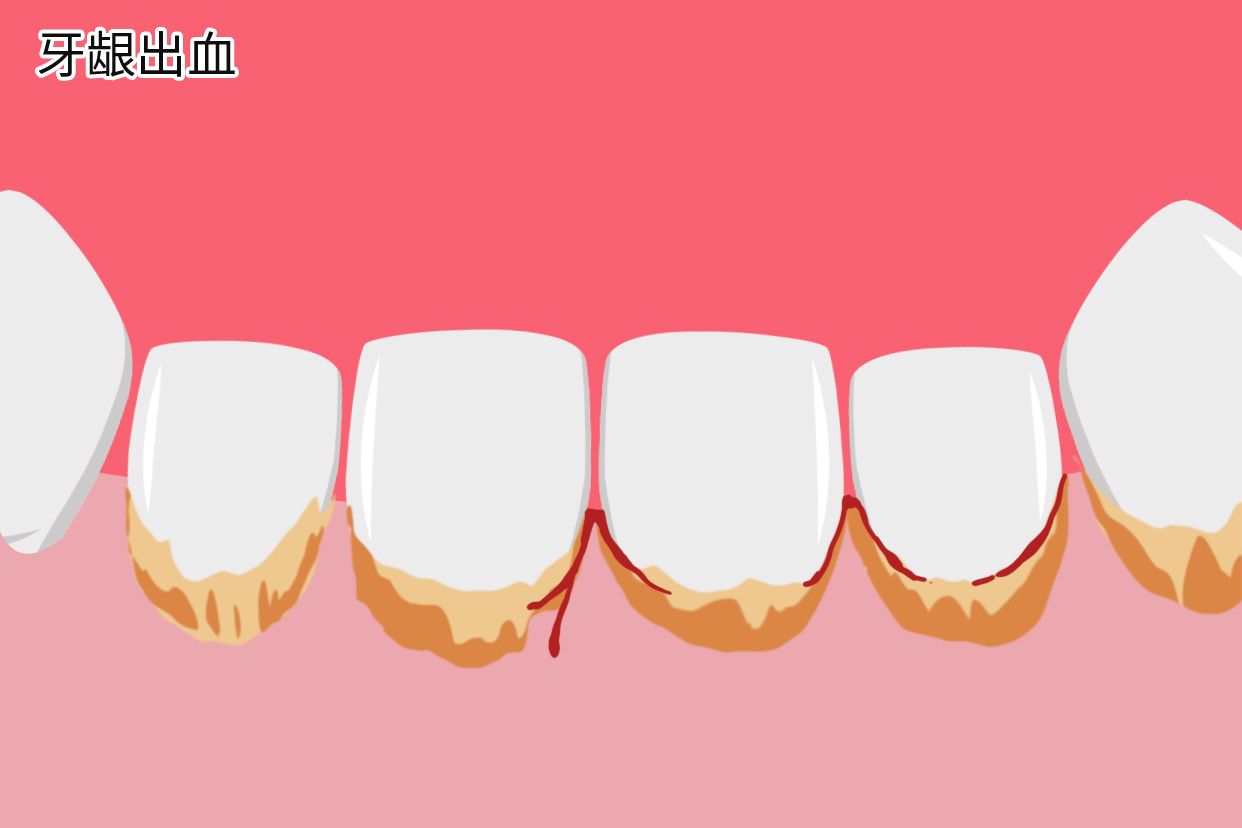 牙结石会导致牙龈出血吗图片（牙结石会导致牙龈出血吗图片）