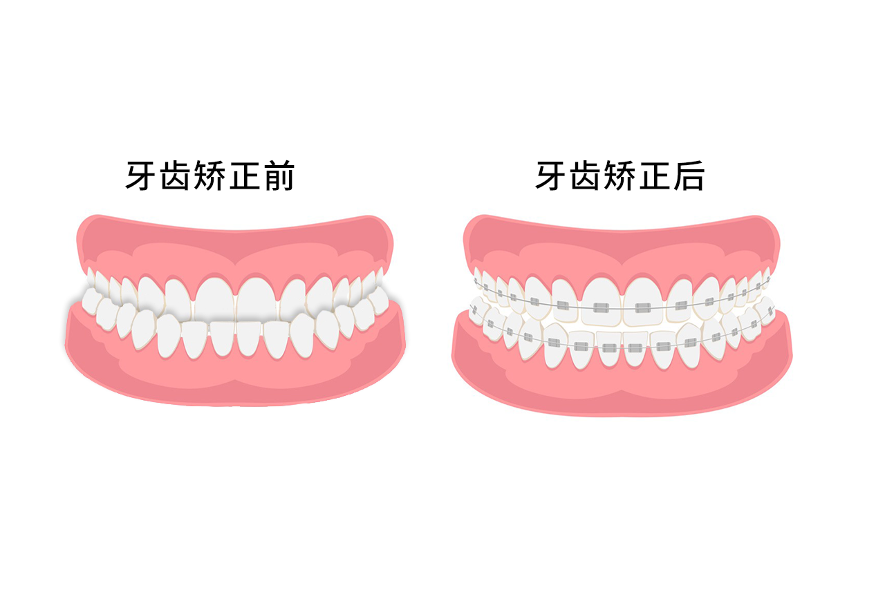 反颌牙齿矫正过程图片 反颌牙齿矫正过程图片视频