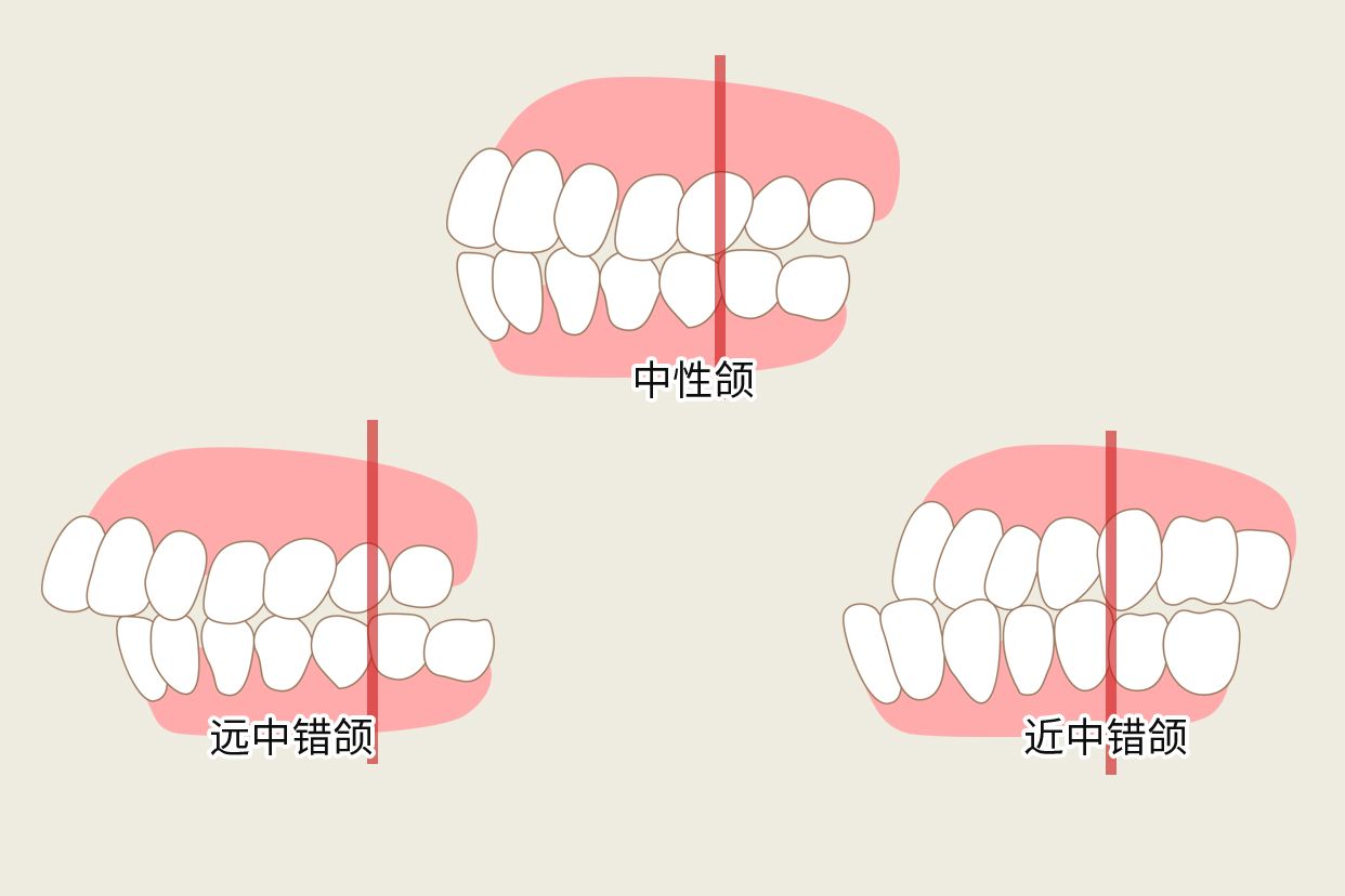 angle错颌分类图解（angle错颌畸形分类法）