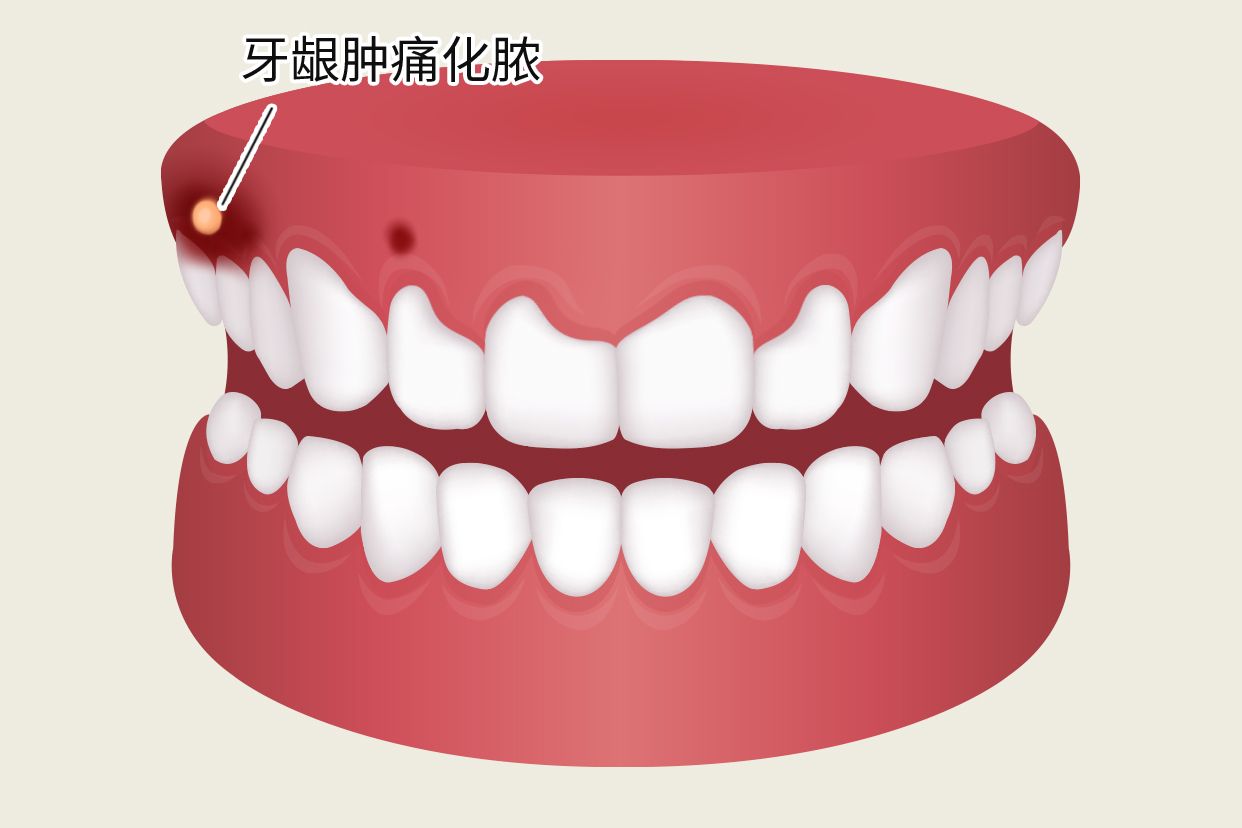 冠周炎牙龈肿痛化脓图片 智齿冠周炎脓肿图片