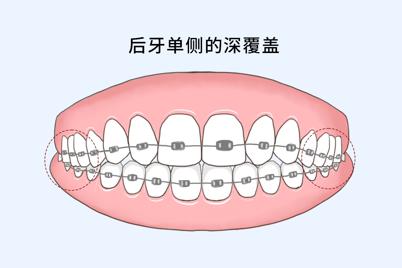 后牙单侧的深覆盖如何矫正图片（单侧后牙反合怎么办）