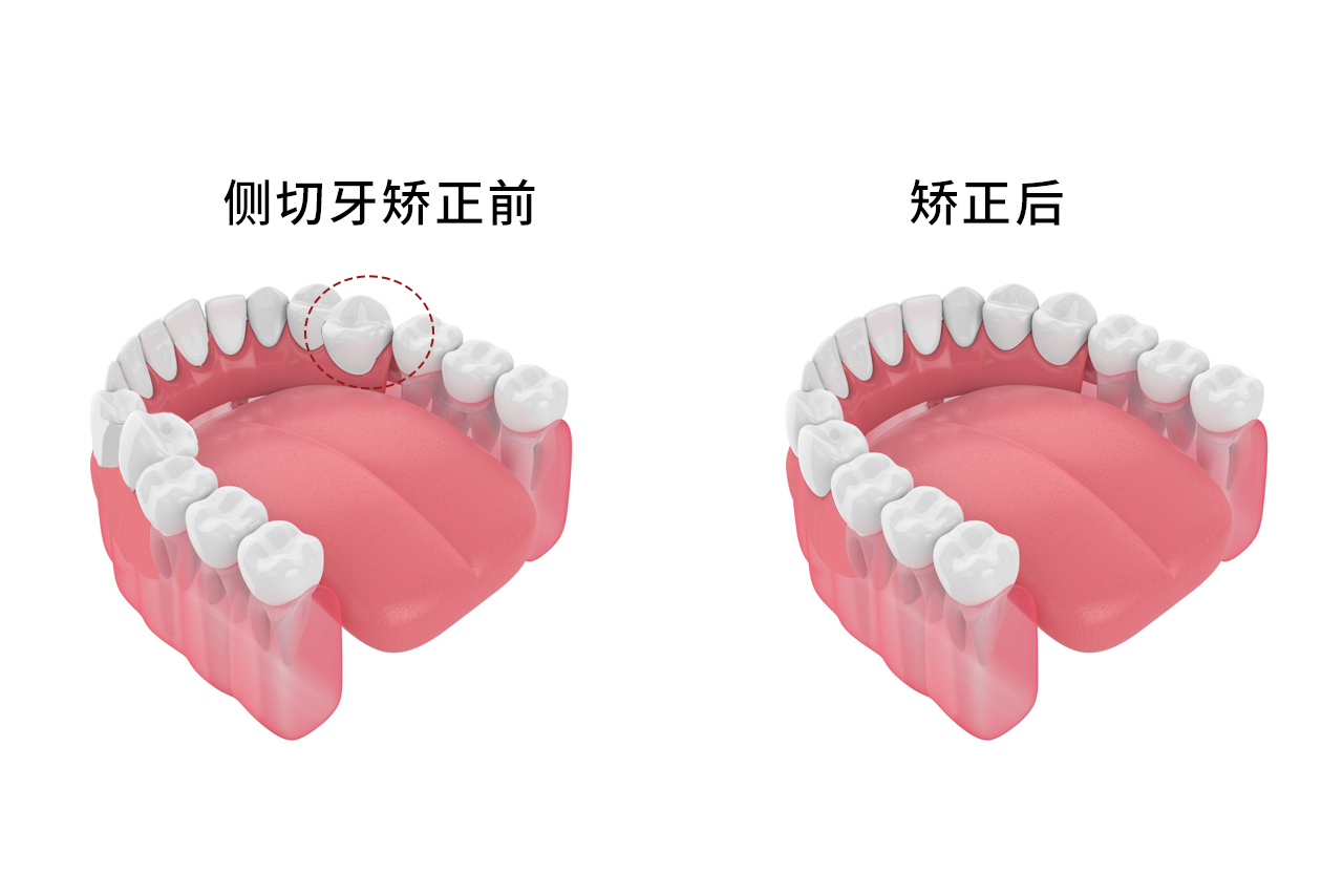 侧切牙小又尖纠正图片（侧切牙尖尖的图片）