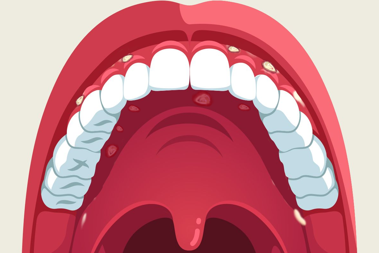 牙龈两侧溃疡图片（牙龈两侧溃疡图片高清）