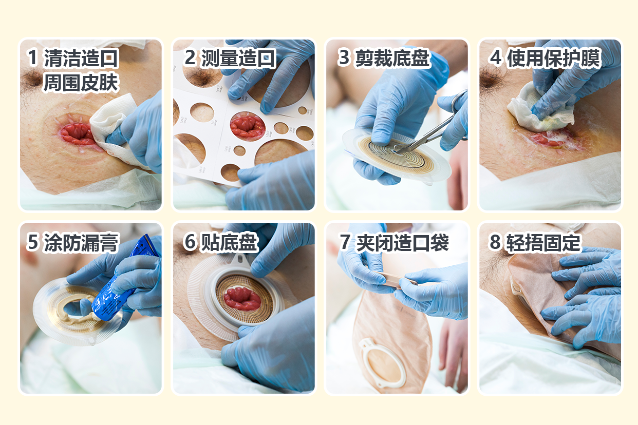 造口更换流程图 造口更换流程及注意事项