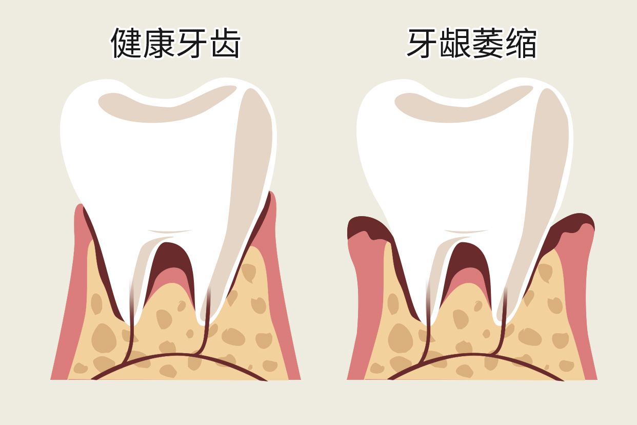 单个牙龈萎缩图片 单个牙龈萎缩图片大全