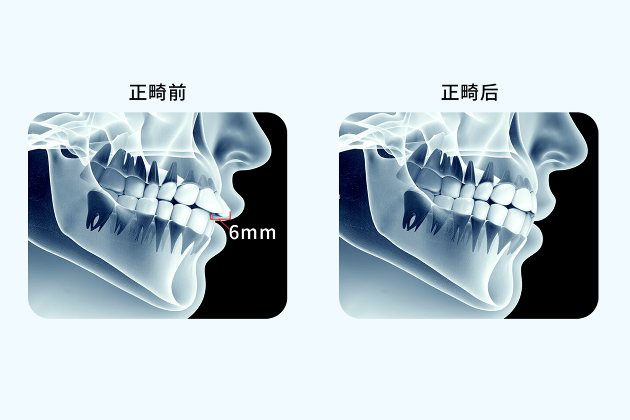 正畸内收6mm效果图（正畸内收2mm）