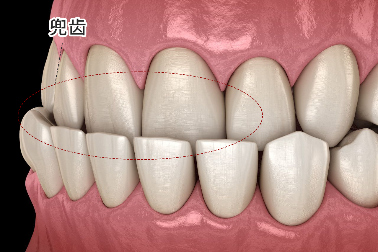 兜齿严重的照片（兜齿怎么回事）