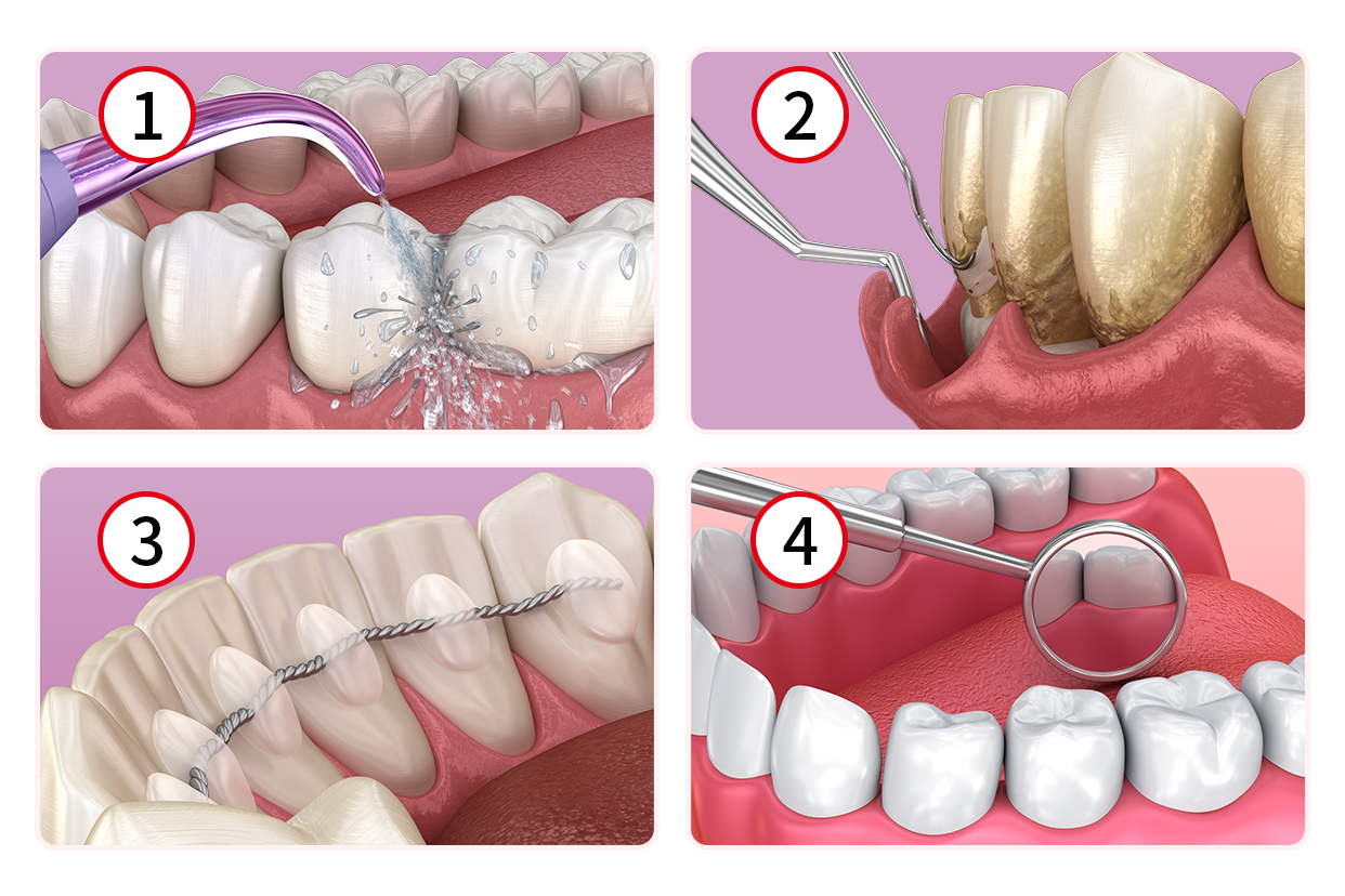 牙周治疗四个步骤图解 牙周治疗是怎么治疗