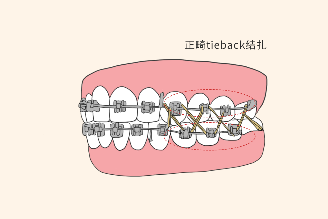 正畸tieback结扎图片 正畸支架图片