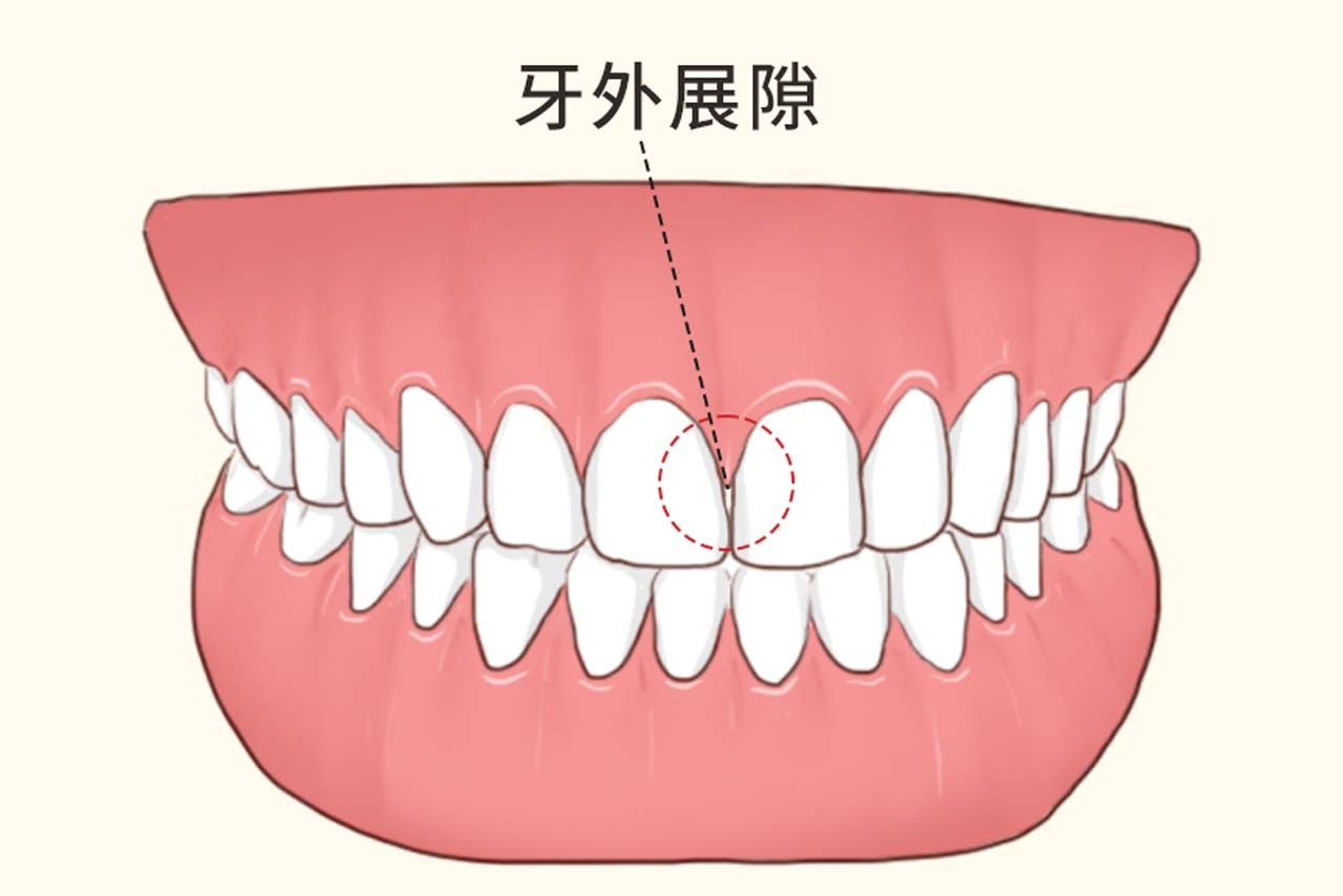 牙外展隙图解（牙齿的外展隙图解）