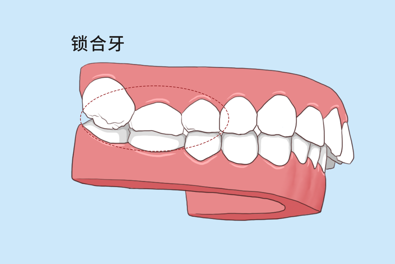 锁合牙图片 锁合牙的治疗方法