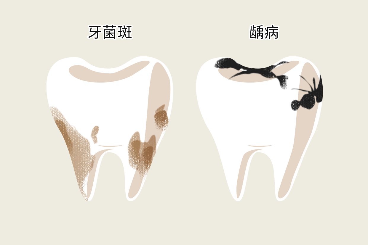 牙垢和蛀牙的区别图片（牙垢和蛀牙的区别图片大全）