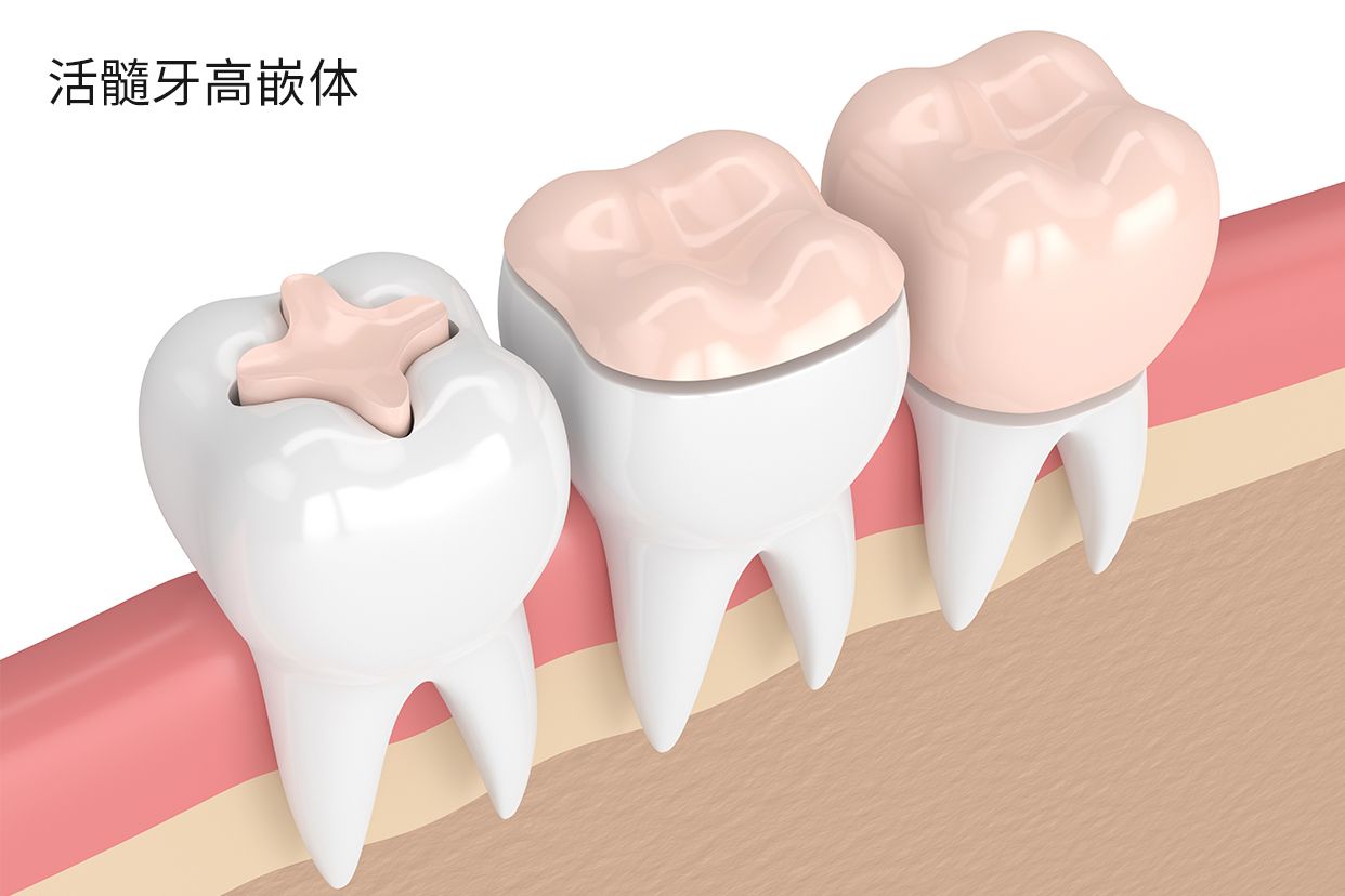 活髓牙高嵌体图片 活髓牙 嵌体