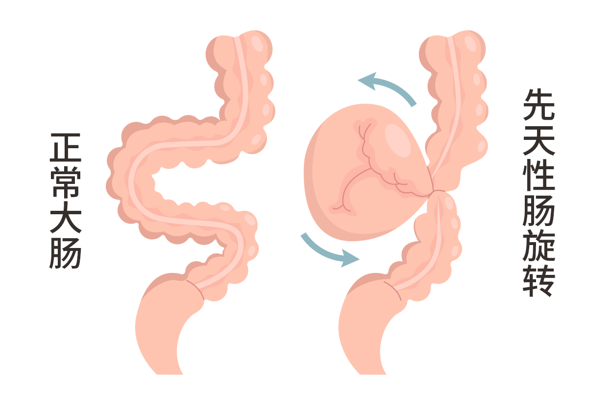 先天性肠旋转不良图片