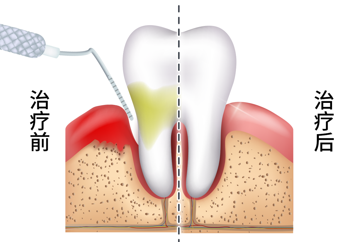 牙周炎牙缝修补效果图