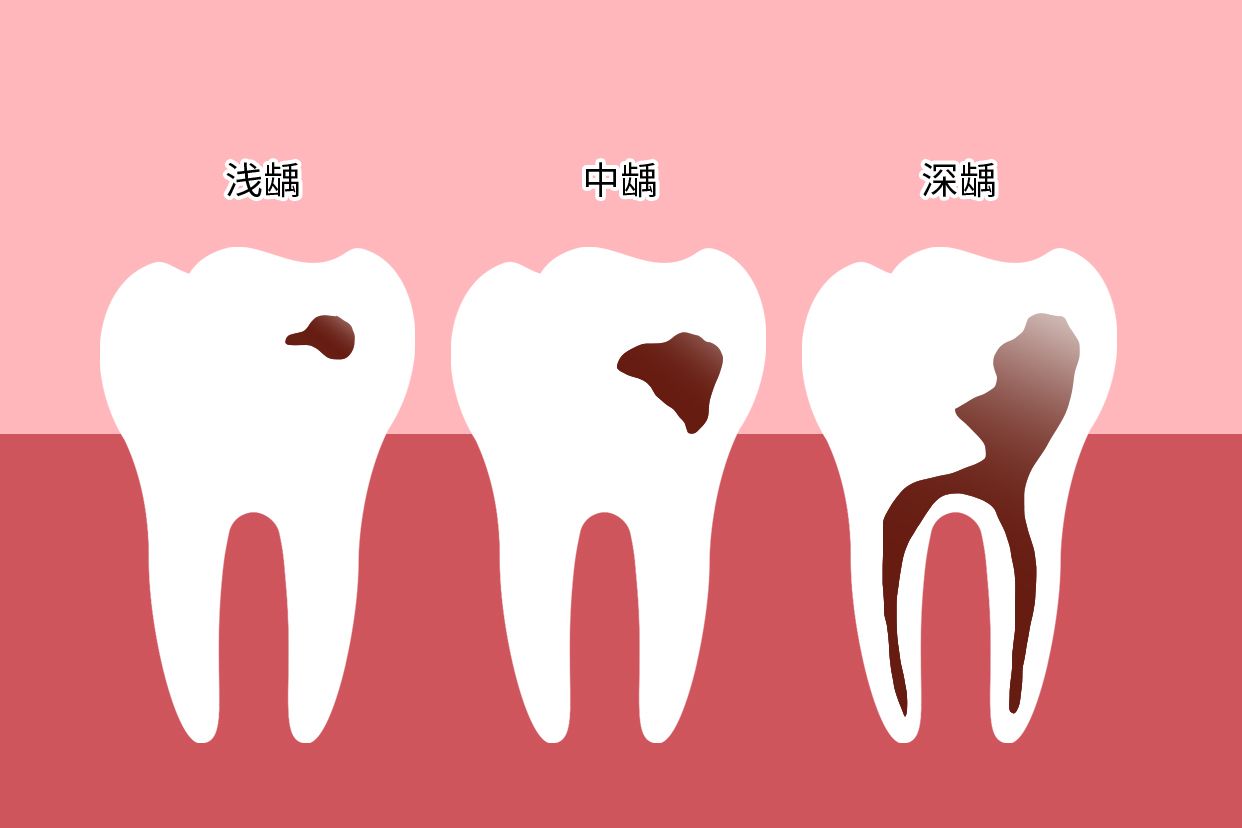 门牙龋齿严重程度分型图片