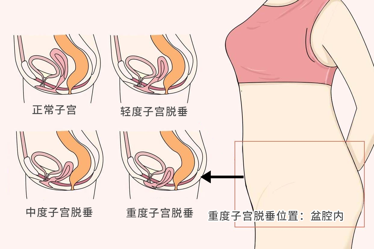 宫颈上吊严重位置在哪呢图片 宫颈吊上去了有影响吗