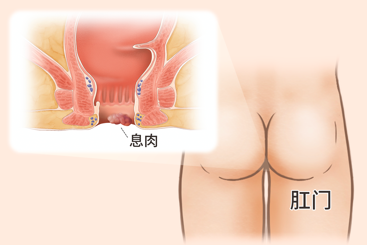 肛门肠息肉图片 肛门肠息肉图片大全