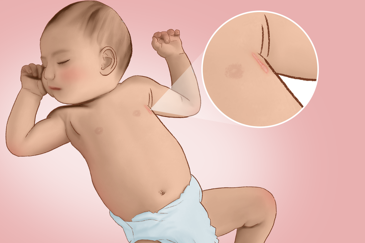 宝宝心脏手术疤痕图片 婴儿心脏手术疤痕能消除掉吗