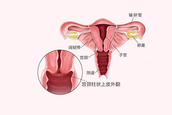 宫颈口外翻是怎么回事图片（宫颈口外翻是怎么回事图片）