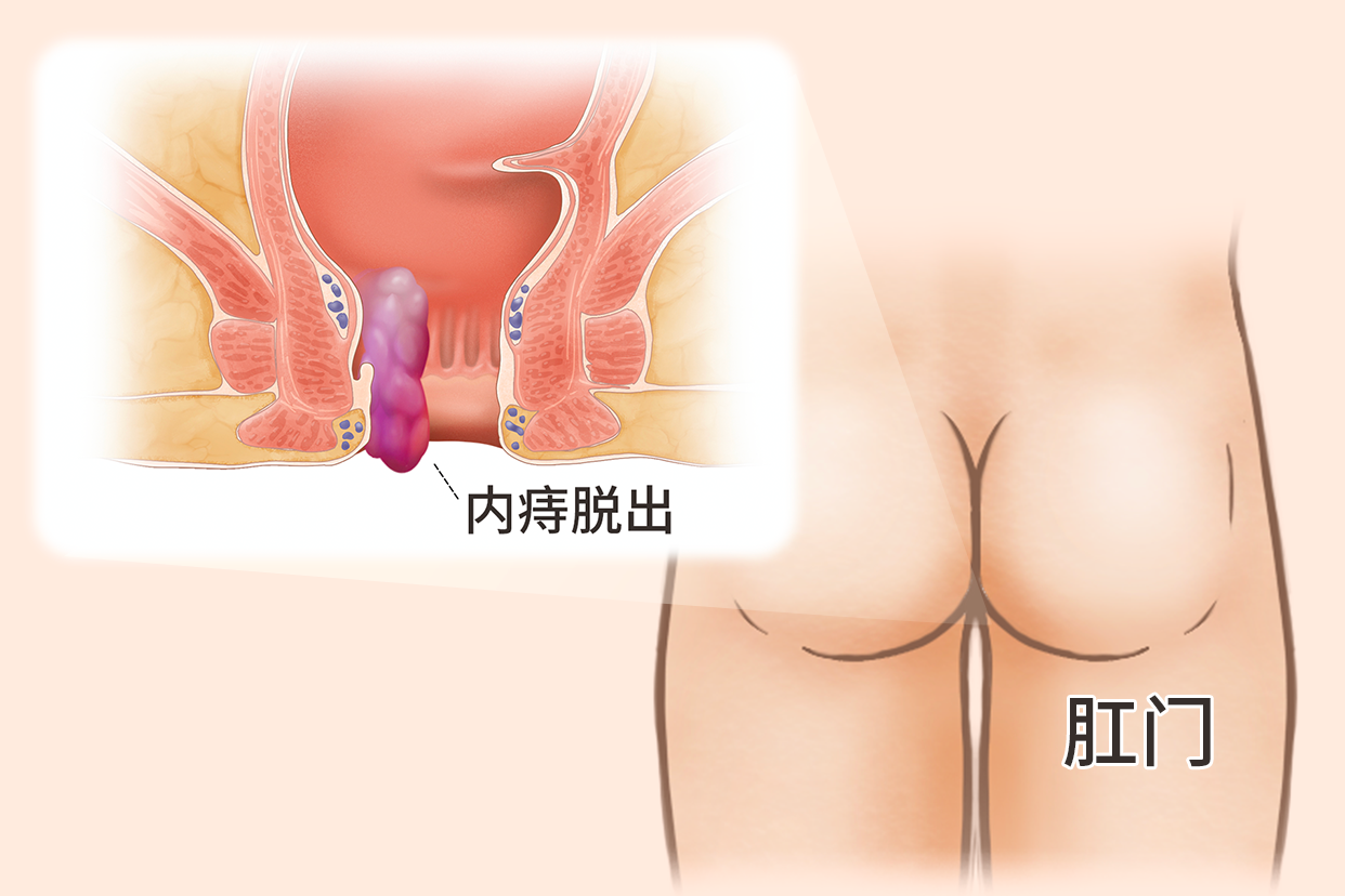 内痔痔核脱出的照片（内痔痔核脱出的照片图片）