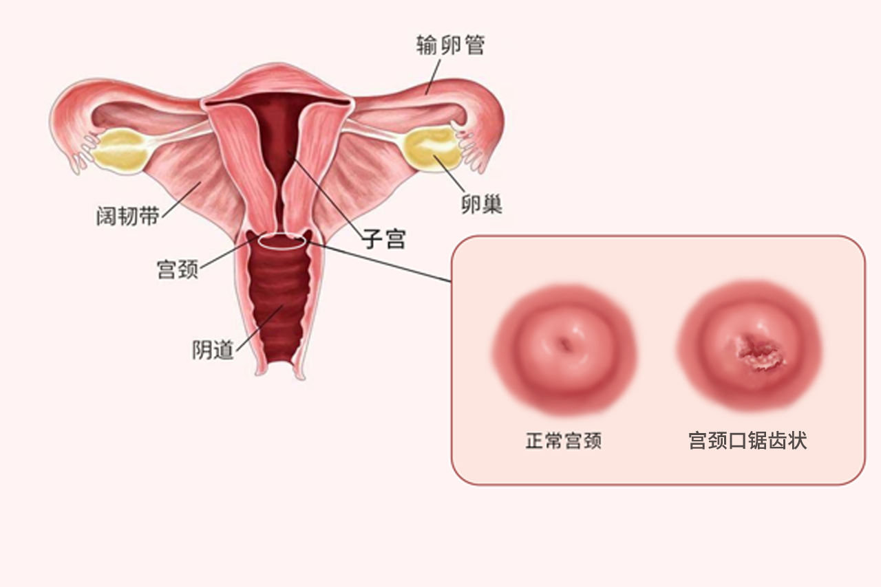 宫颈口锯齿状图片 宫颈口锯齿形