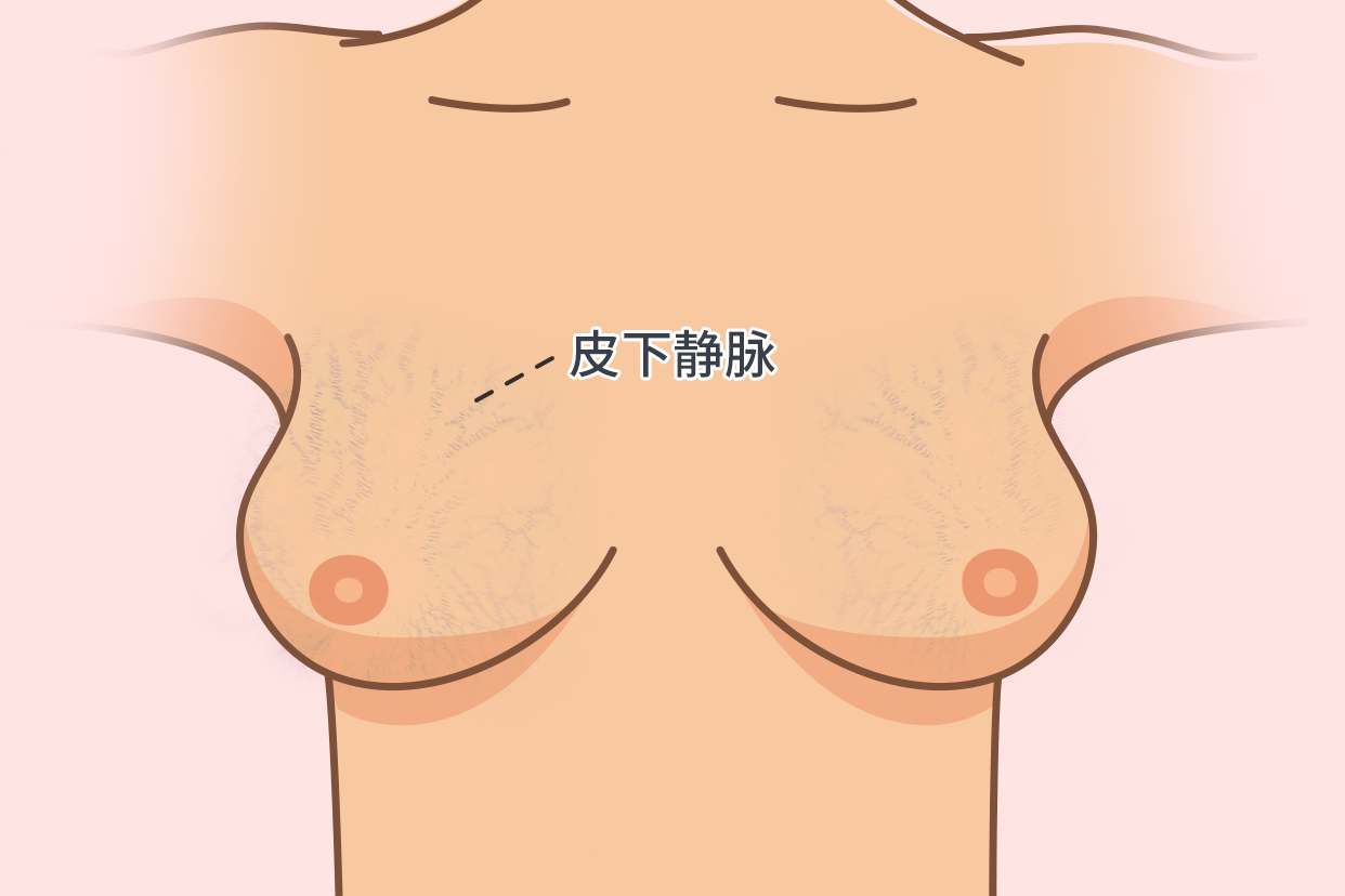 乳房皮下静脉图片（乳房皮下静脉明显是怀孕了吗）