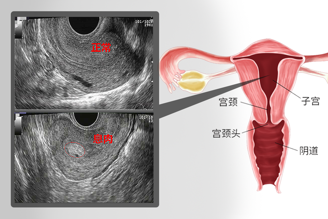 子宫息肉的b超图像（子宫息肉b超报告是什么样）