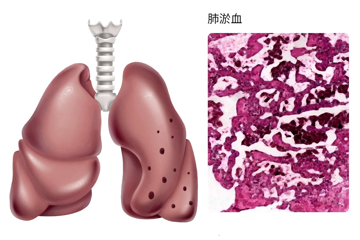 肺淤血图片 肺淤血图片 手绘图