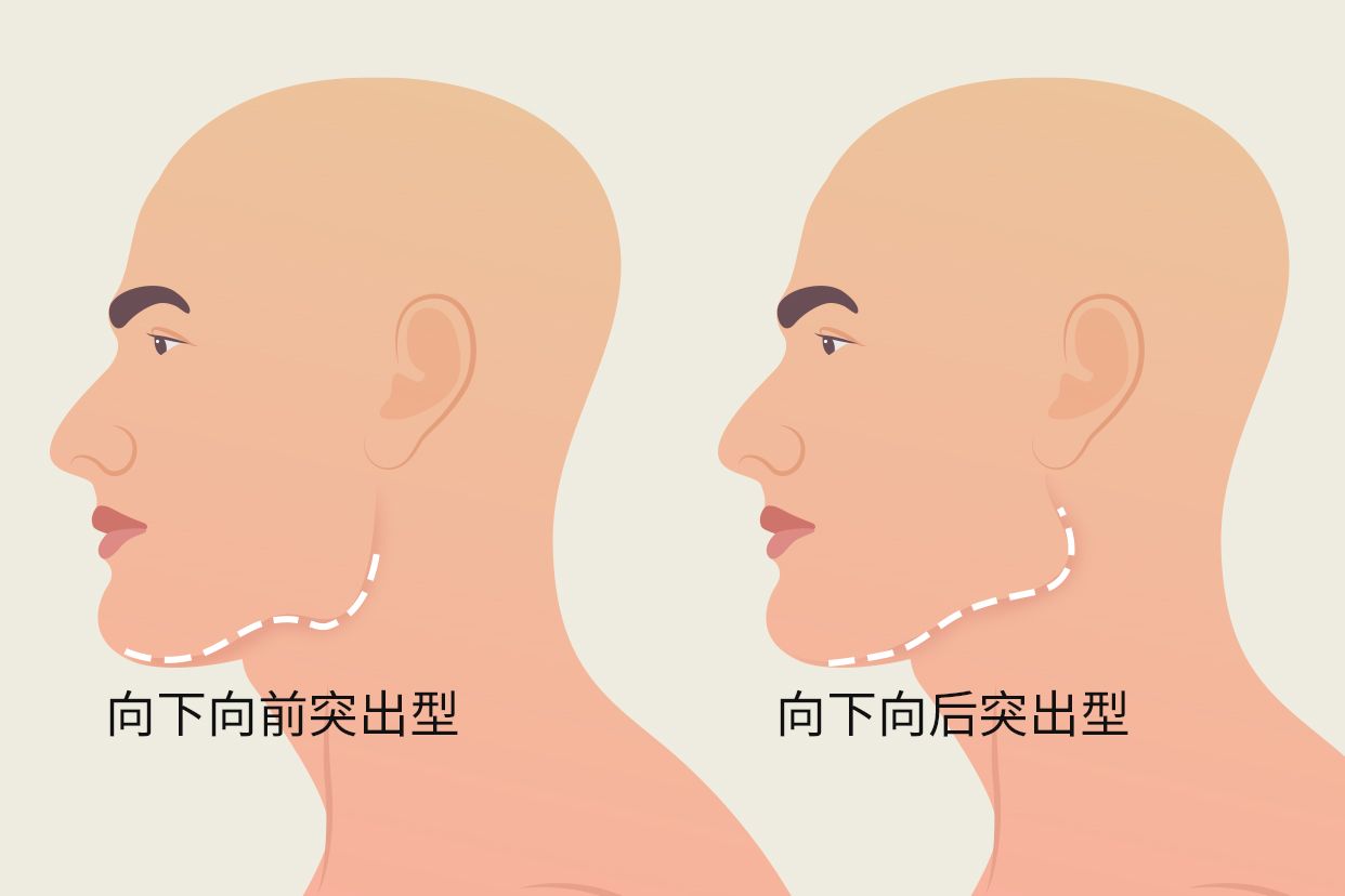 下颌骨向下突出图片男 下颌骨向下突出图片男孩