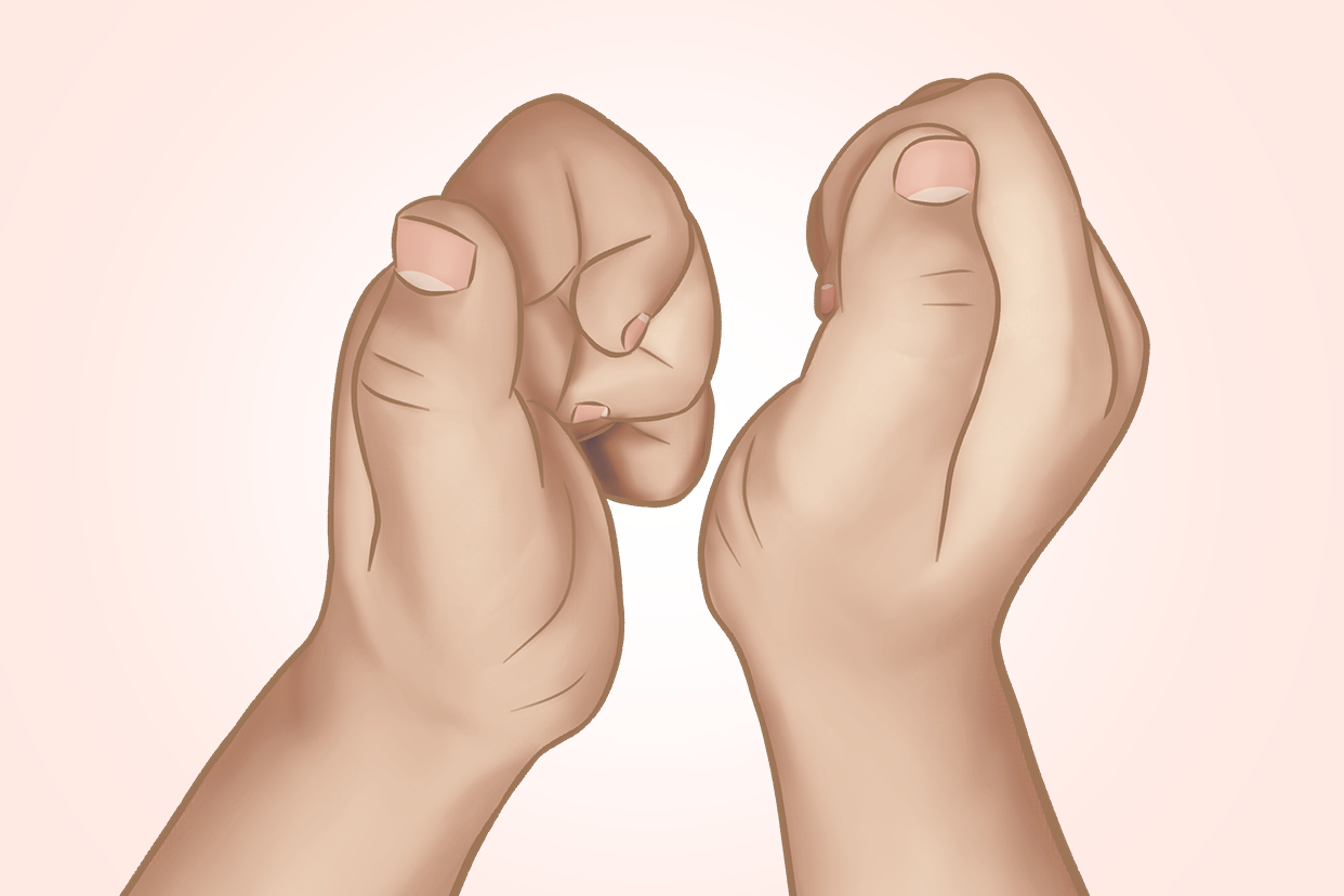 孩子十个手指伸不直图 手部常见的五种畸形