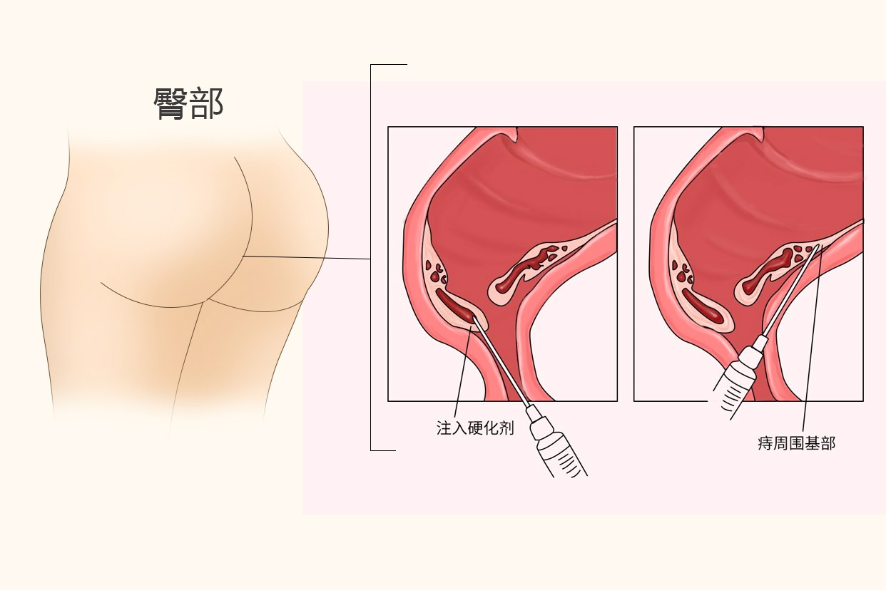 痔疮打针后一个星期后图片（痔疮打针后几天能烂完不痛了）