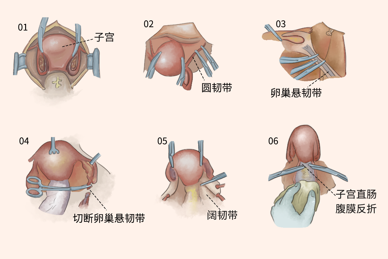 子宫卵巢的切除手术示意图（子宫卵巢的切除手术示意图片）