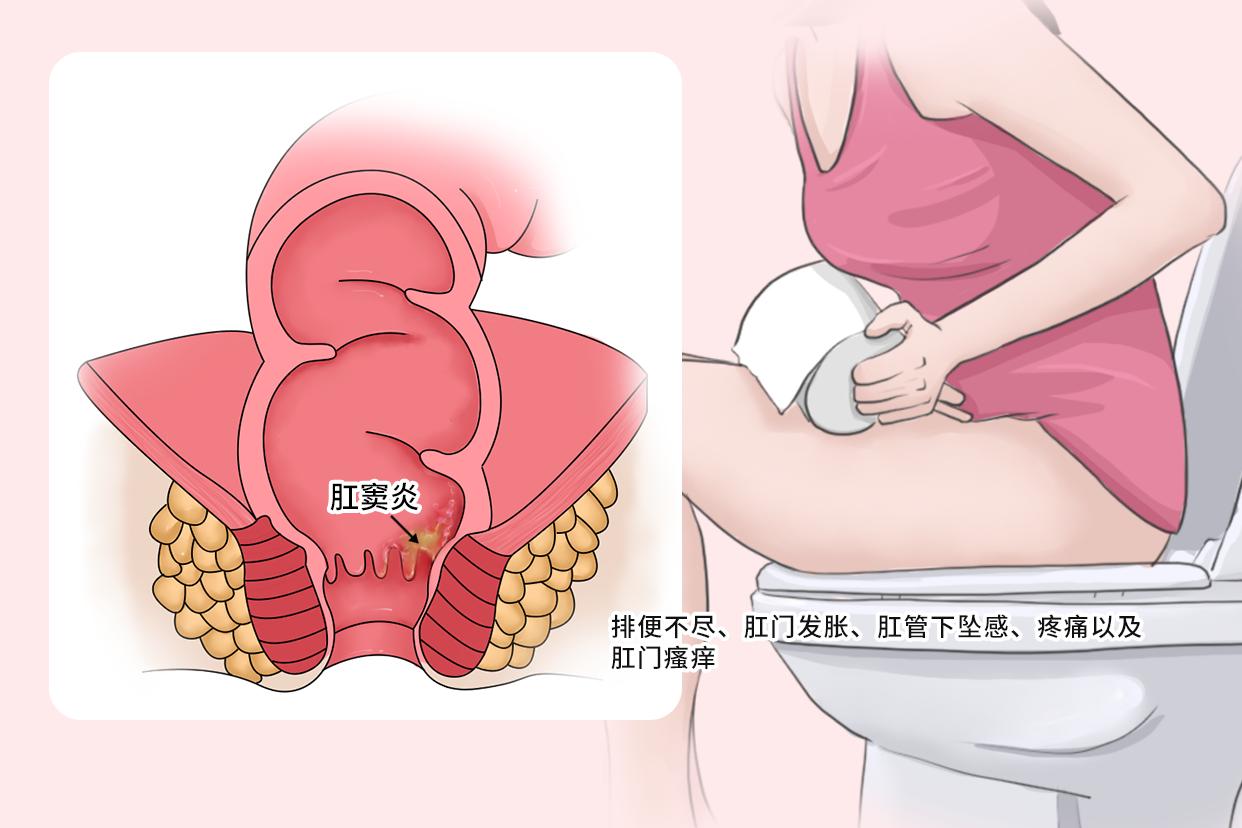 女性肛窦炎的症状图片（怎么判断是不是肛窦炎）