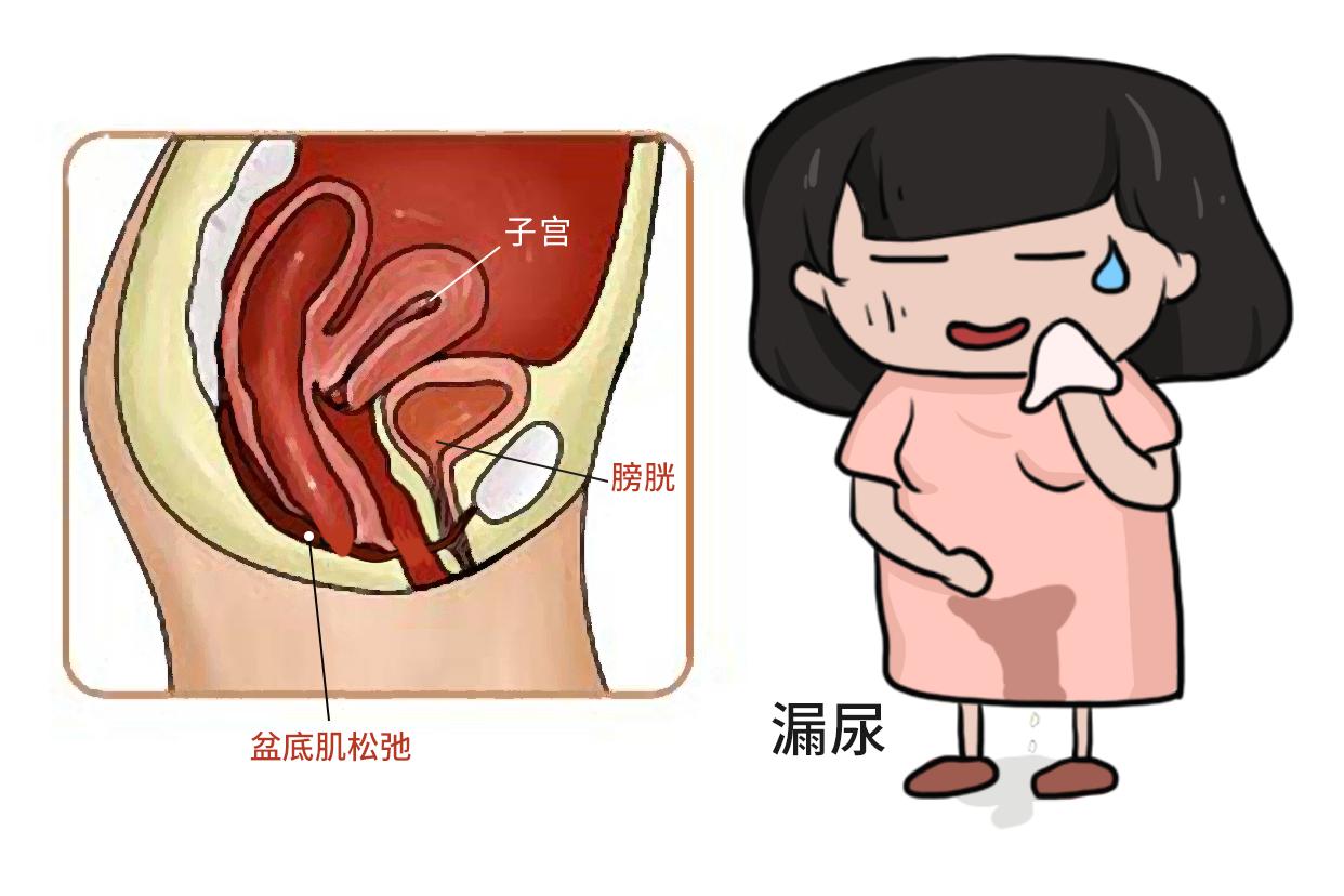 盆底肌松弛漏尿图片（盆底肌松弛漏尿是什么症状）