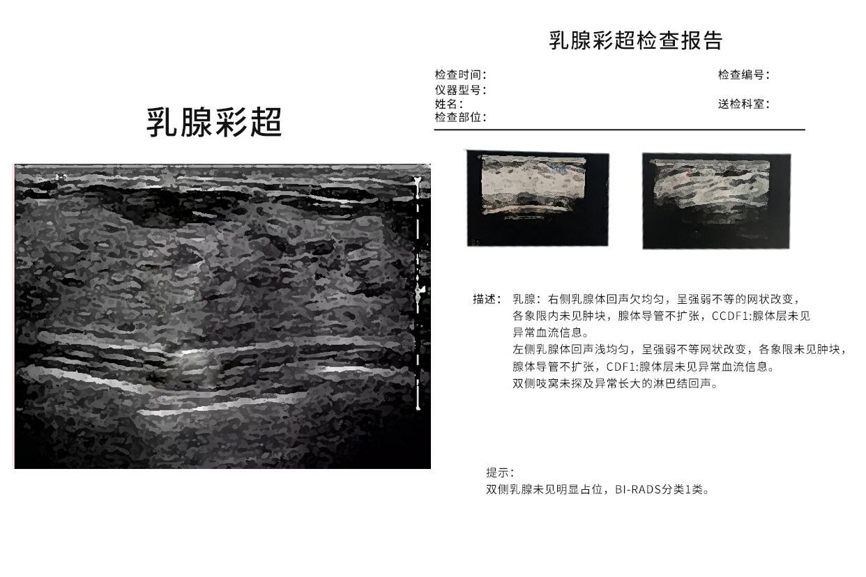 乳腺彩超报告看图片还是看结果 乳腺彩超报告看图片还是看结果好