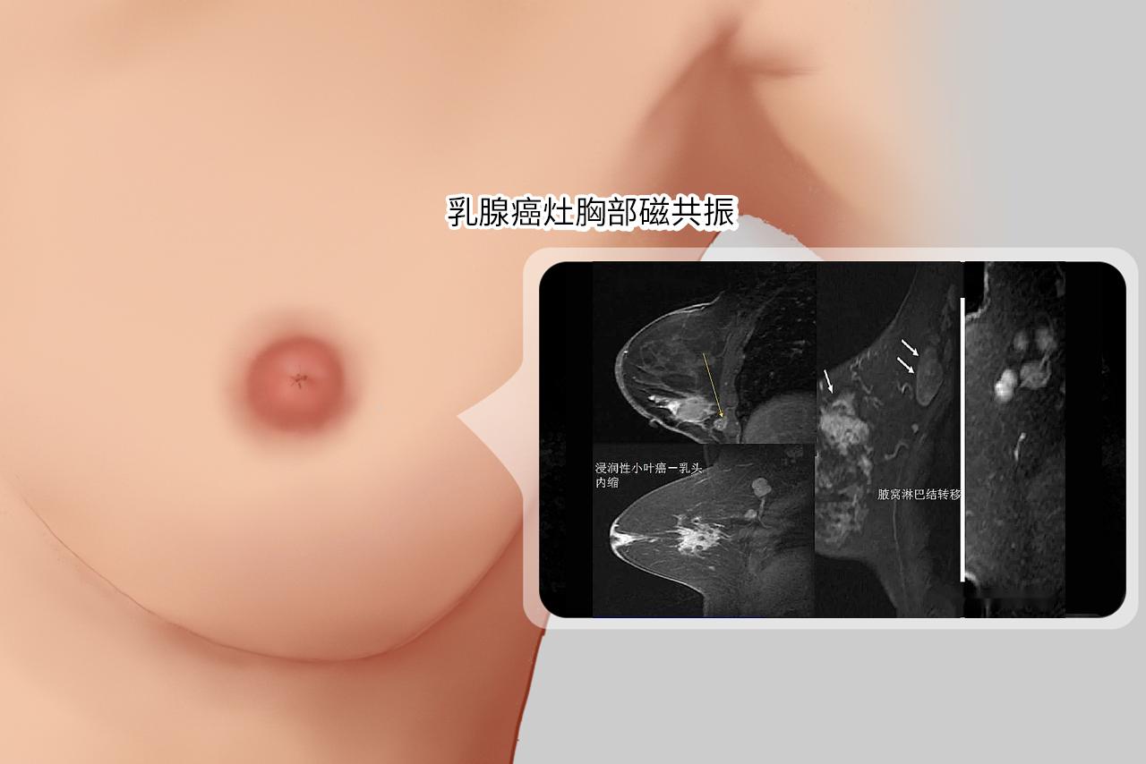 乳腺癌灶胸部磁共振图片 乳腺癌在核磁共振结果显示什么