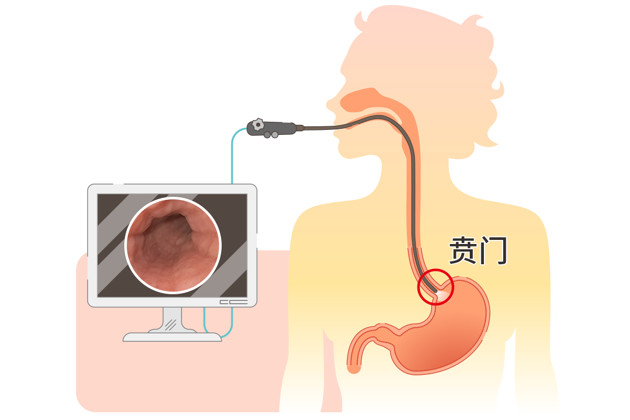 胃镜正常的贲门图片 胃镜检查贲门