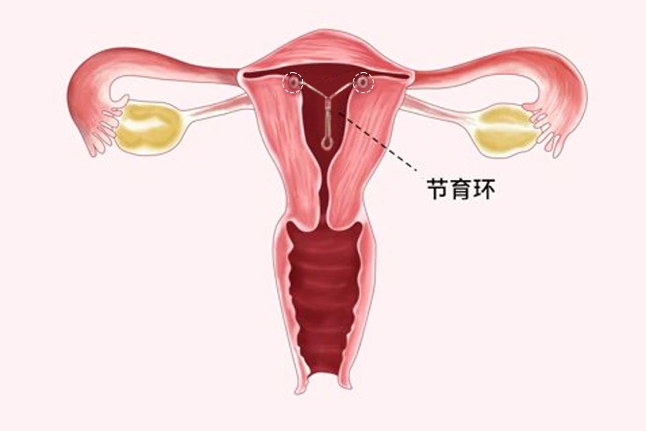 带环长肉上的图片 带环环会不会长肉里