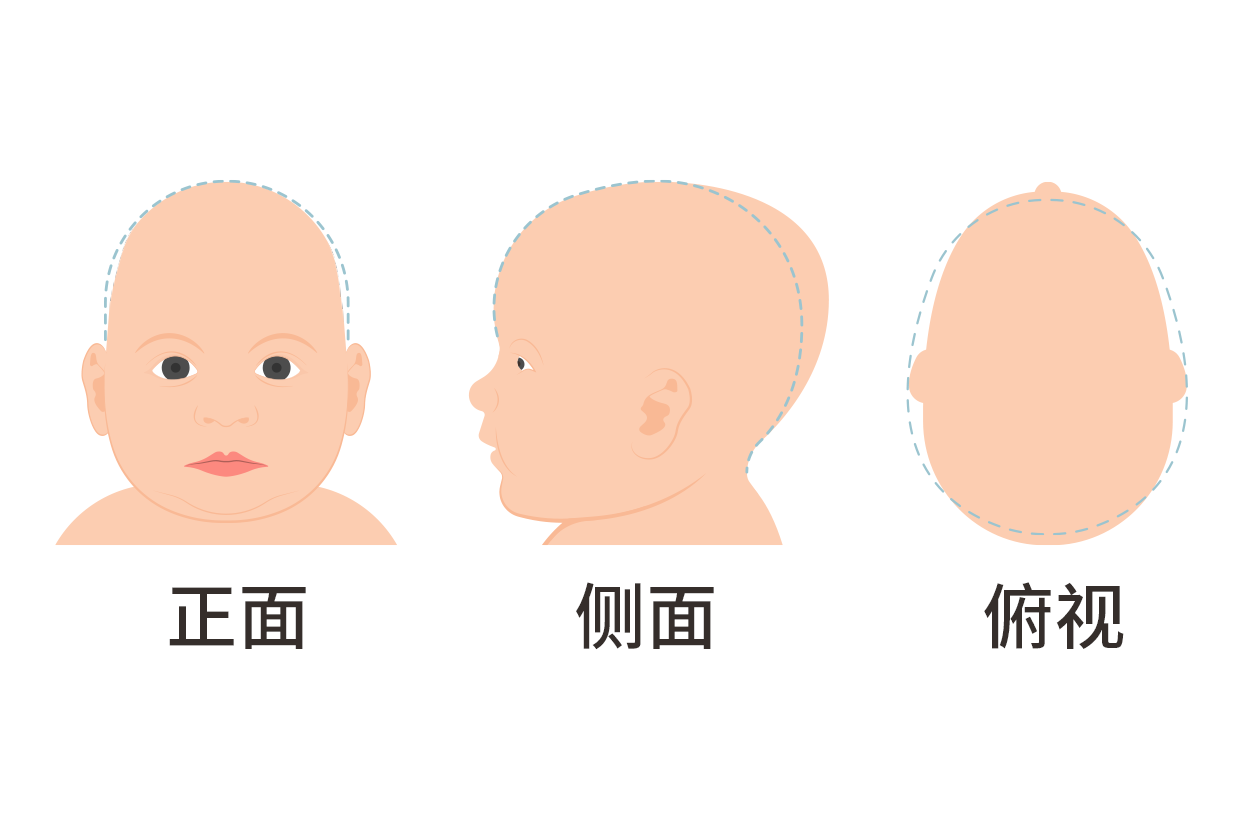 婴儿头两侧有凹陷怎么回事图片 婴儿头两侧有凹陷怎么回事图片大全