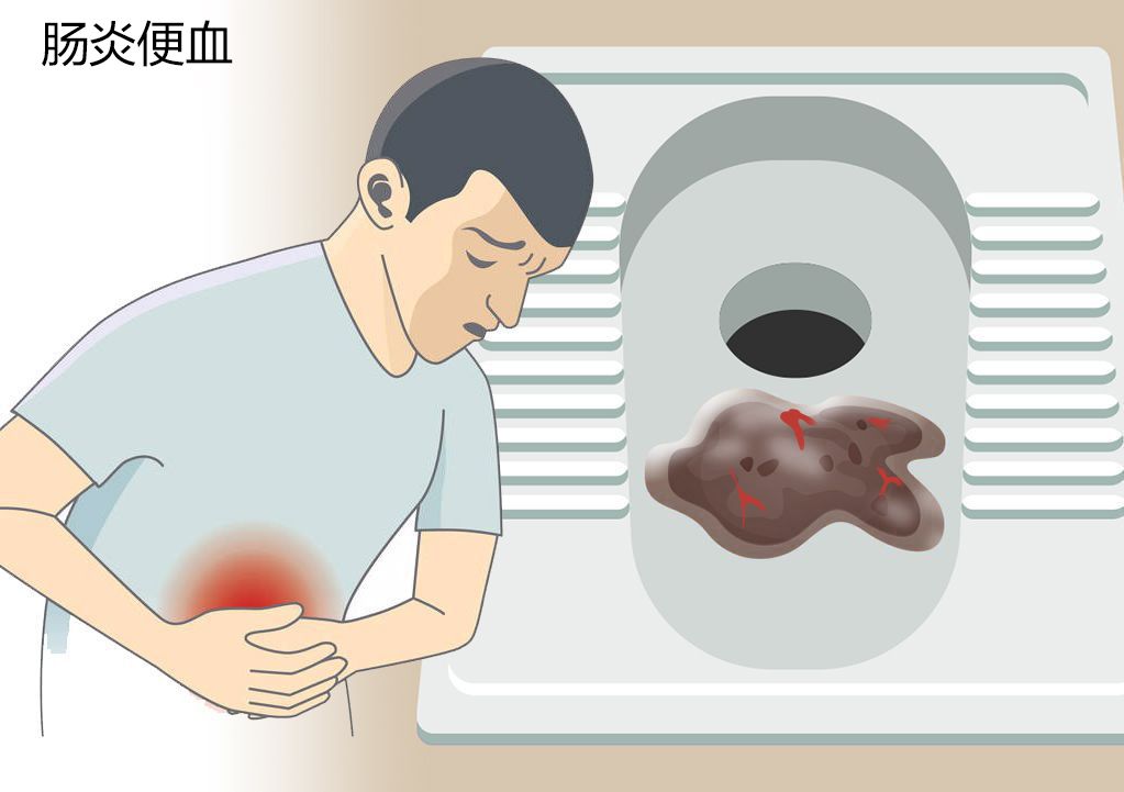 肠炎便血图片 肠炎大便图片