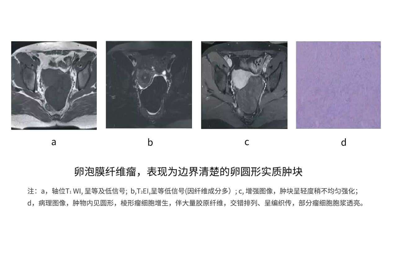 纤维卵泡膜细胞瘤图片 纤维卵泡膜细胞瘤图片高清