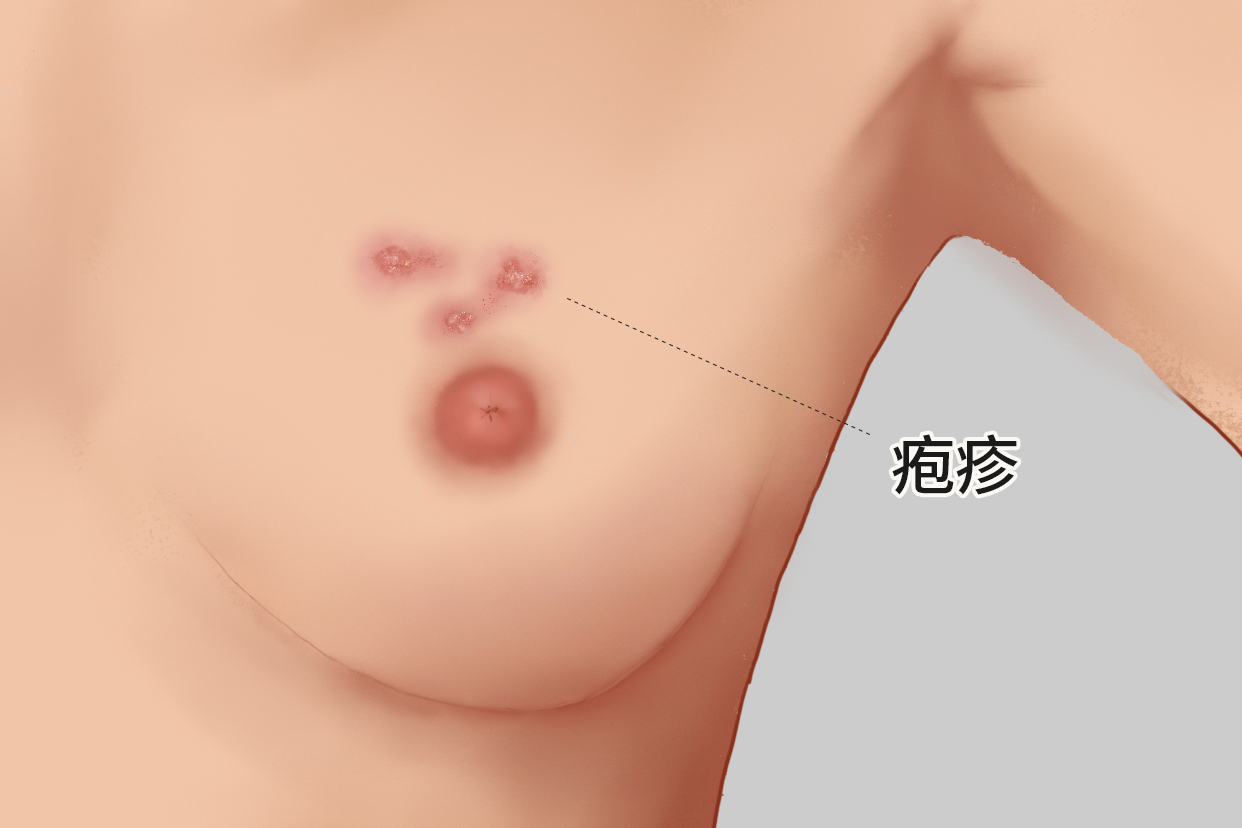 女性乳房长疱疹图样（乳房上长疱疹是否癌变）