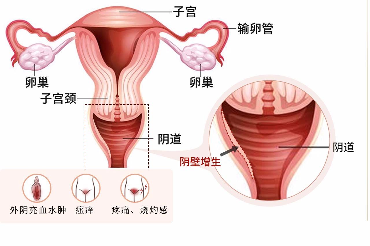 阴壁增生症状图片