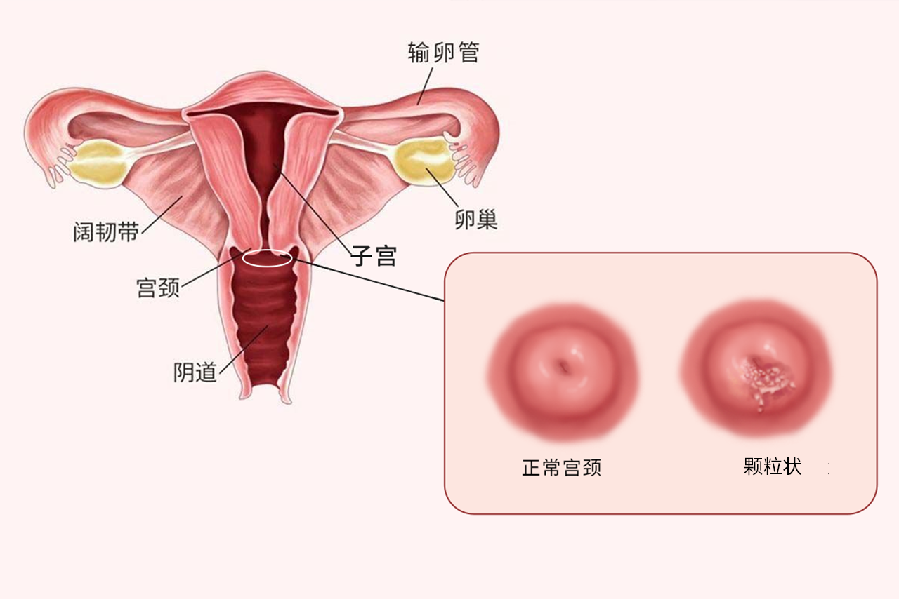 宫颈糜烂颗粒状图片