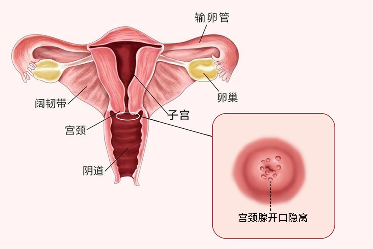 宫颈腺开口隐窝图片