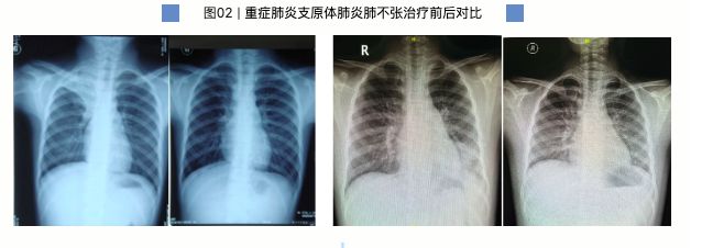 女生肺叶变白妈妈拒住院：耽误功课 医生：康复后学习更有效